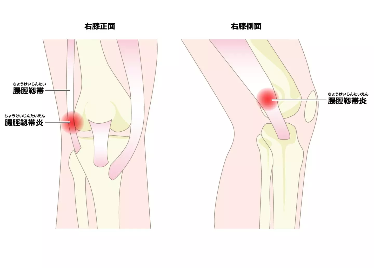 腸脛靭帯炎のメカニズム
